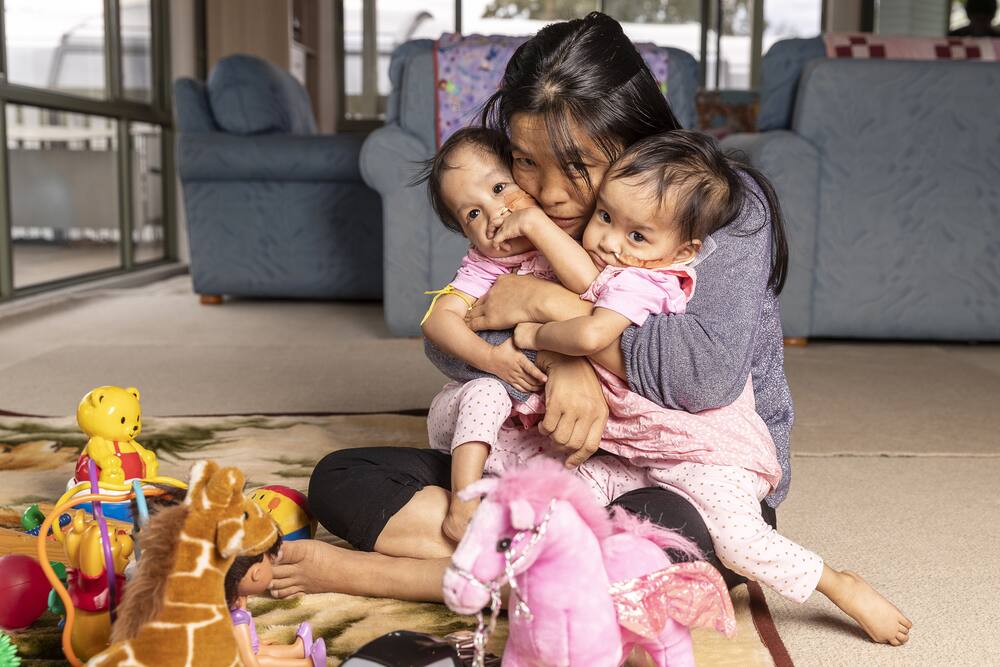 Bei OP getrennt: Siamesische Zwillinge trotzdem unzertrennlich