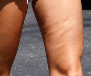 Hilft Kaffee Gegen Cellulite Tipps Fur Den Knackigen Po Blick