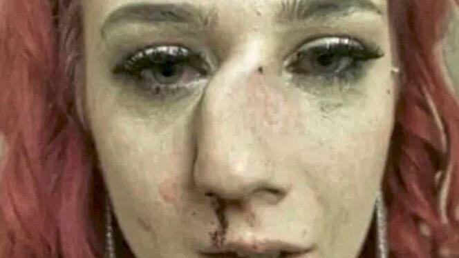 Emma Clark Wird Nach Model Wettbewerb Die Nase Gebrochen Blick Emma Clark Wird Nach Model Wettbewerb Die Nase Gebrochen Blick