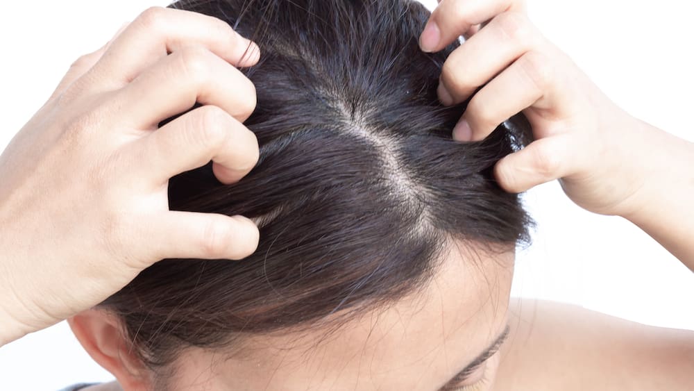 schuppen haarausfall schuppen haarausfall