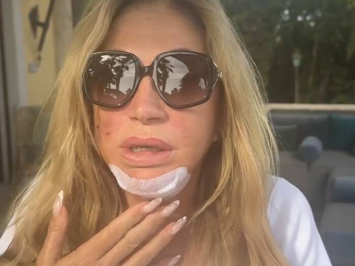 Carmen Geiss zeigt ihre Verletzung