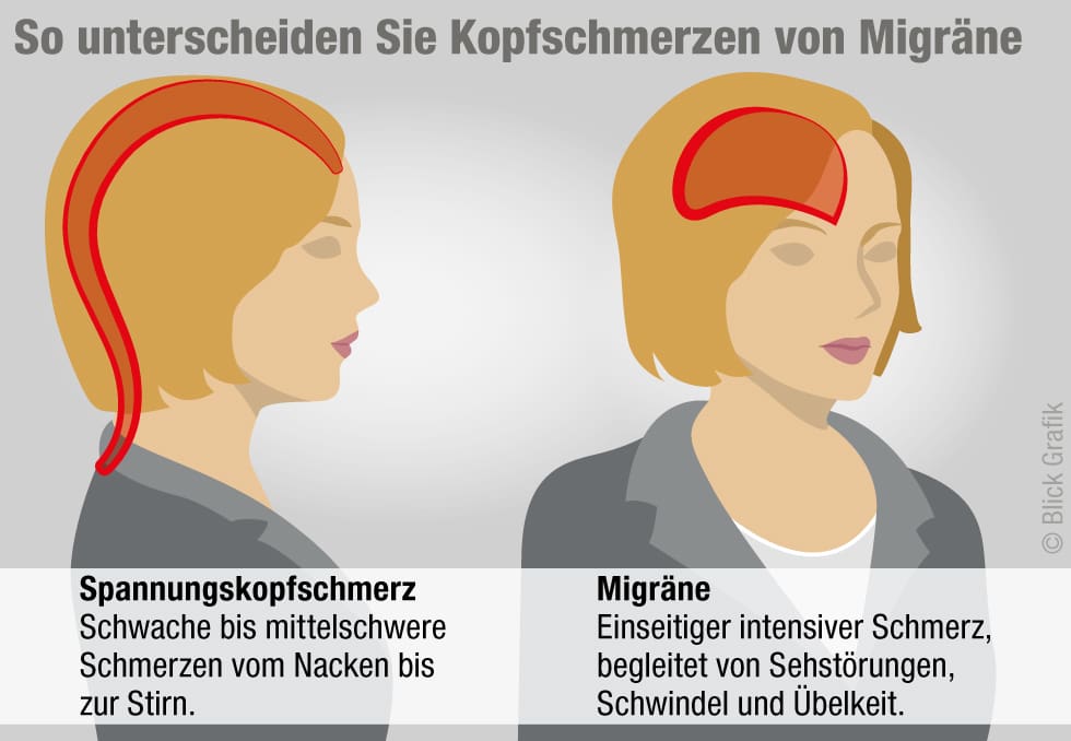 Das müssen Sie über Migräne wissen: Ursachen & Symptome - Blick