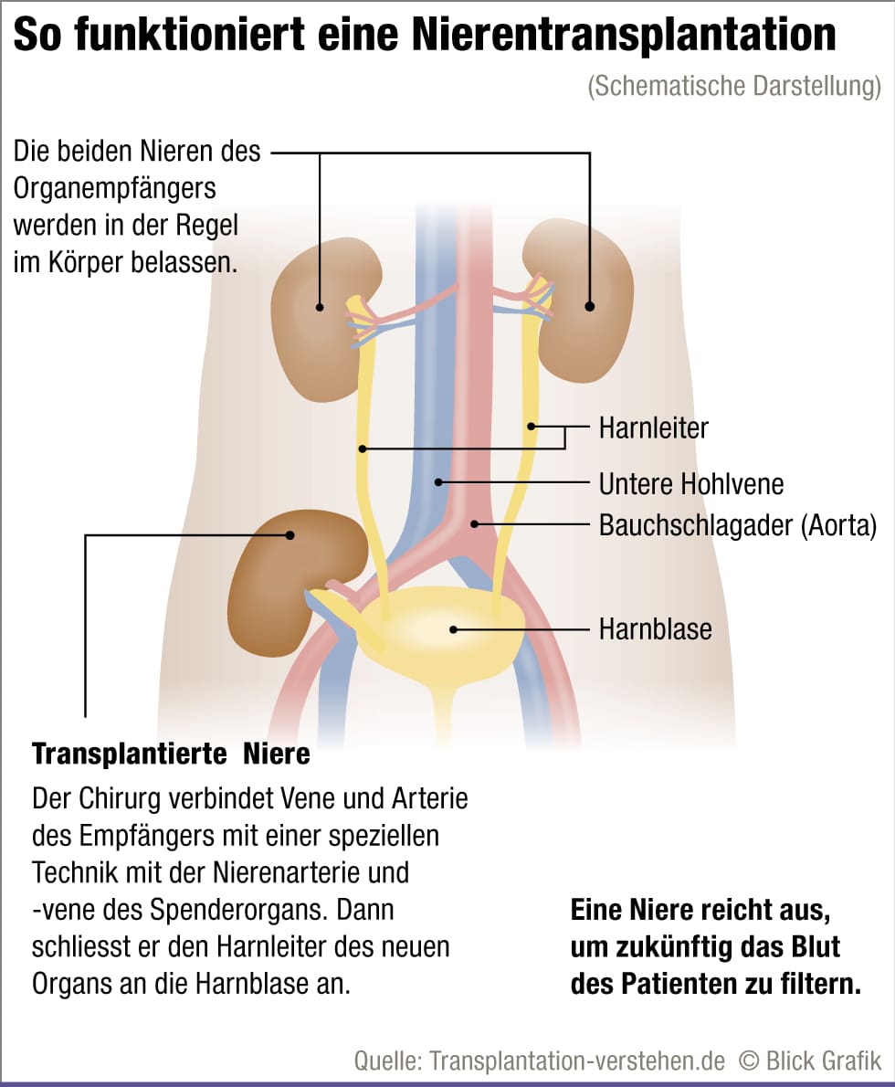 Nierentransplantationen – so funktioniert das in der Schweiz - Blick
